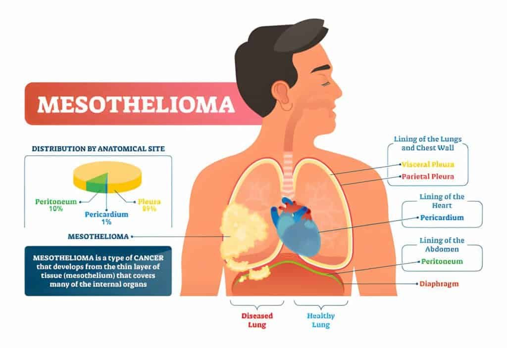 Mesothelioma lawyer